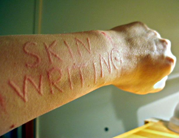 20070312170502sudanDermatographic_urticaria.jpg Hosting at Sudaneseonline.com