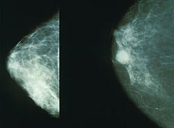 250px-Mammo_breast_cancer.jpg Hosting at Sudaneseonline.com