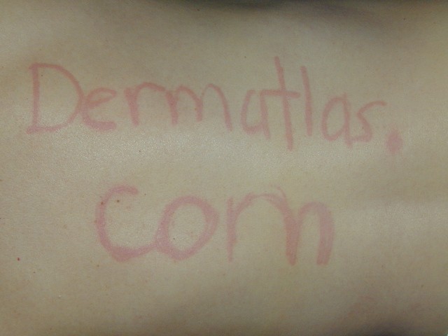dermatographism_1_010729.jpg Hosting at Sudaneseonline.com